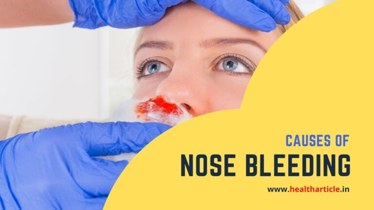 Nose Bleeding: Treatment, Causes, First Aid treatment